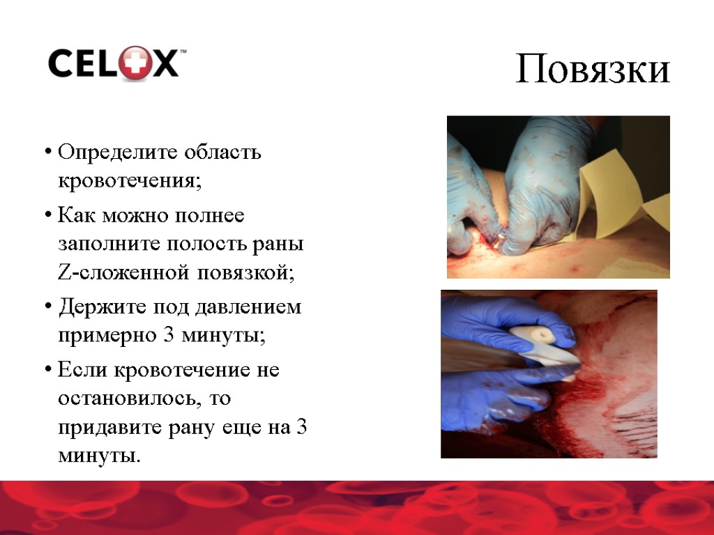 Повязки Определите область кровотечения; Как можно полнее заполните полость раны Z-сложенной повязкой; Держите под